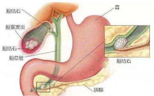 胆囊 胆管 胃 胰腺位置图  胆囊结石的原因